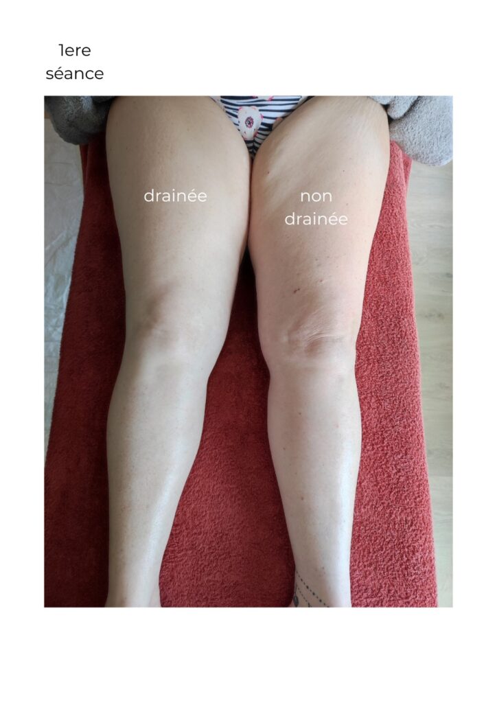 Avant après d’un drainage lymphatique des jambes après une première séance chez MILLODIE